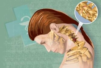 A méhnyak osteokondrózis reflex tünetei
