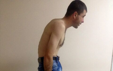 A spondylitis ankylopoetica az évek során derékfájást okozhat